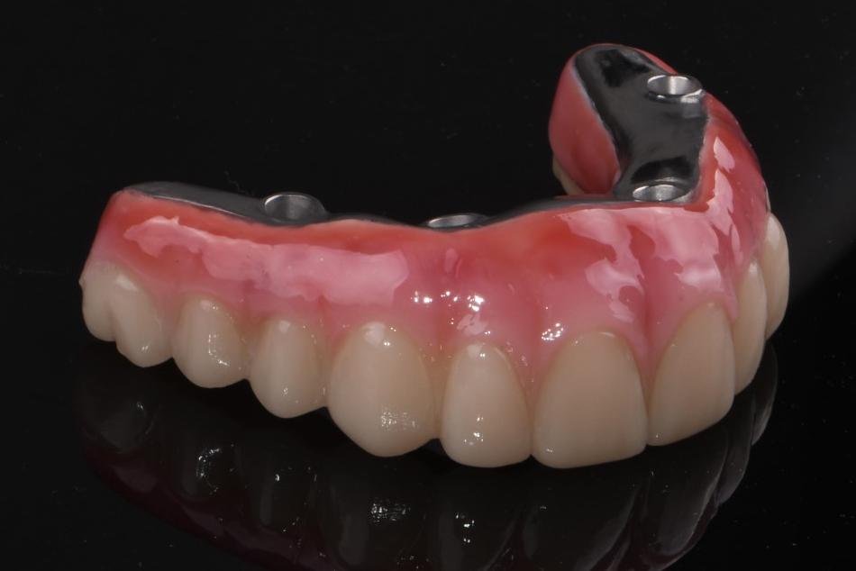 Implant hybrid dentures 1