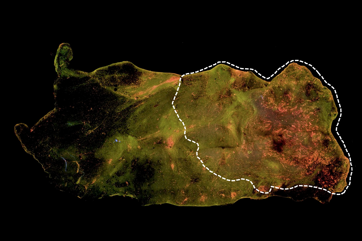 How AI can reduce the need for repeat lumpectomies